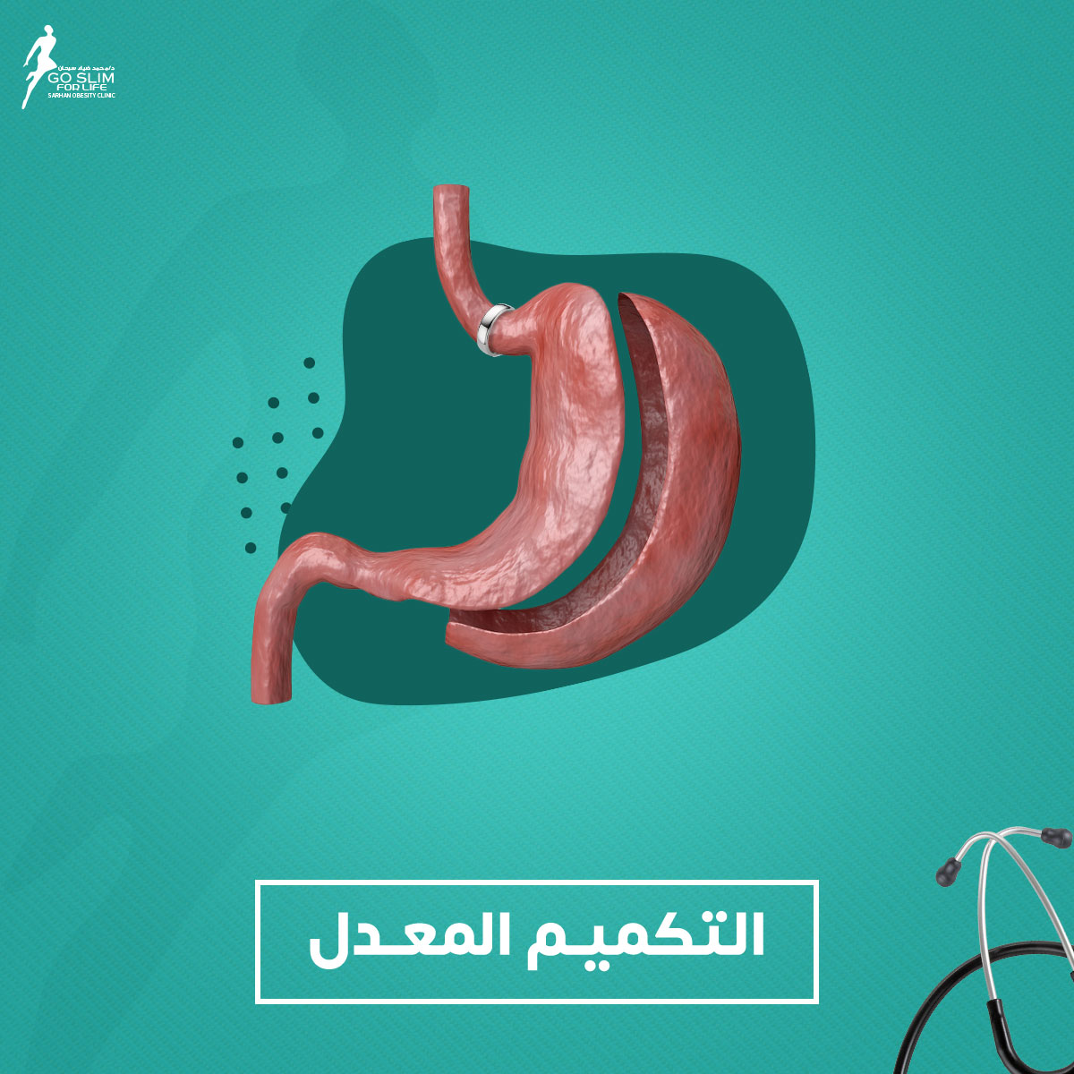 التكميم المعدل